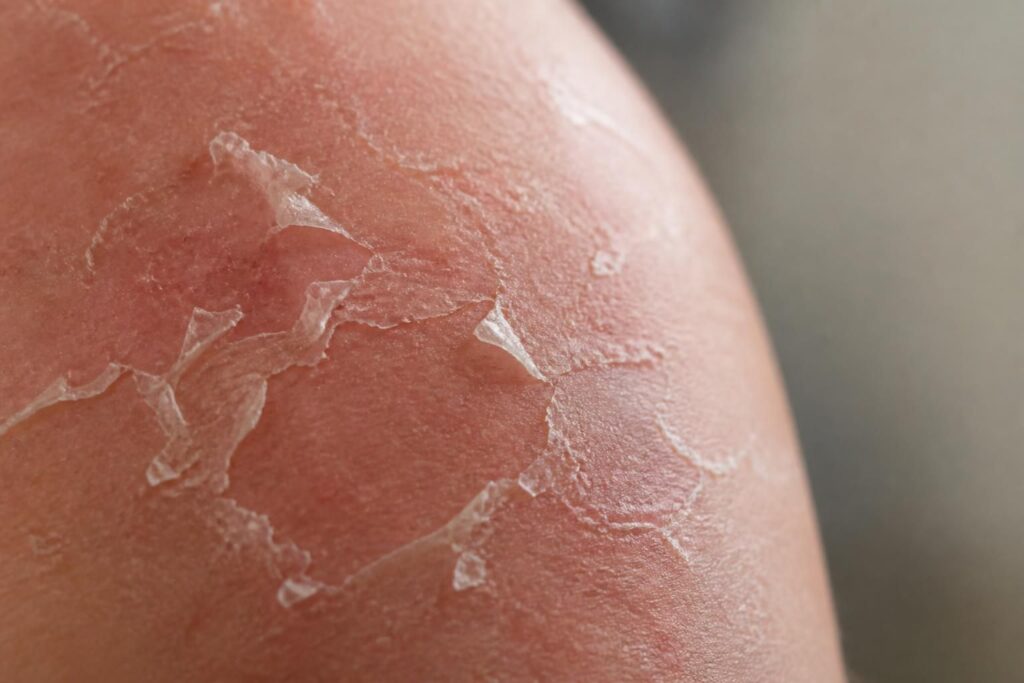 découvrez les causes de la desquamation de la peau et pourquoi votre épiderme se décolle par plaques, pour mieux comprendre et prendre soin de votre peau.